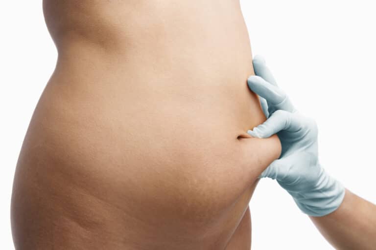 Studies Attempt To Find “Maximum Liposuction Amount” For Body Contouring Patients