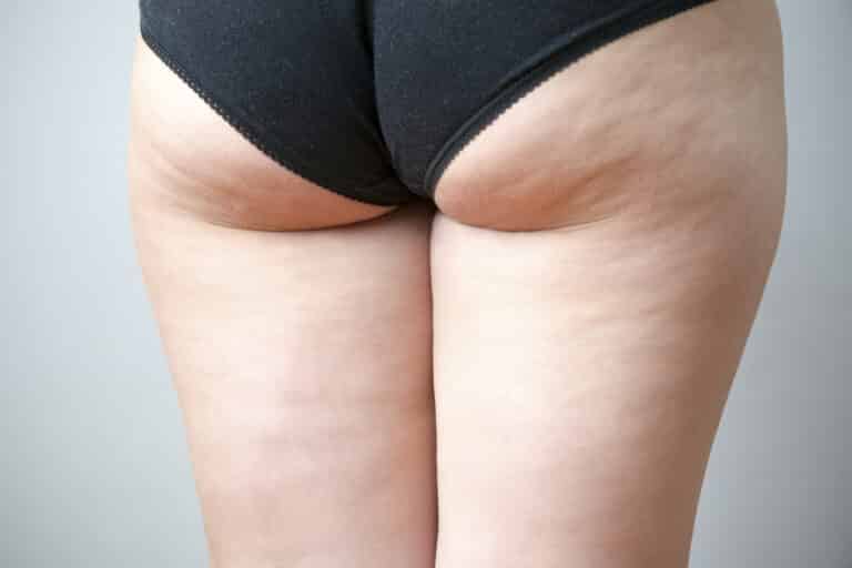 Three Types Of Buttock Enhancements And Contouring Surgeries