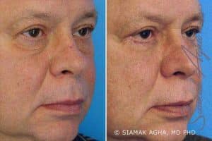 Blepharoplasty Newport Beach, CA