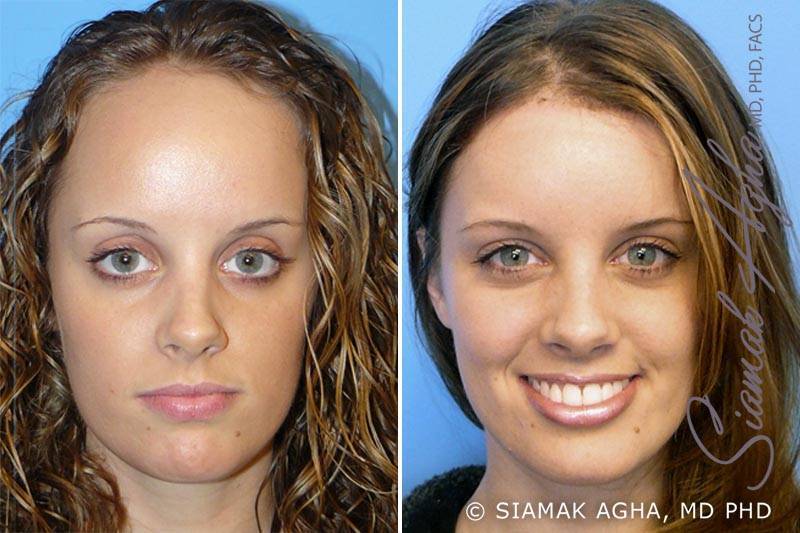 forehead reduction patient 1 front Newport Beach, CA