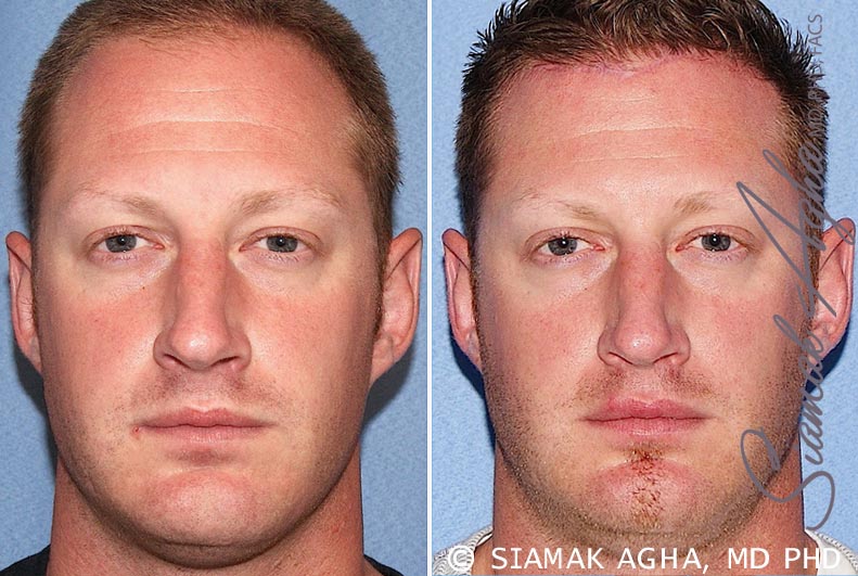 forehead reduction patient 2 front Newport Beach, CA