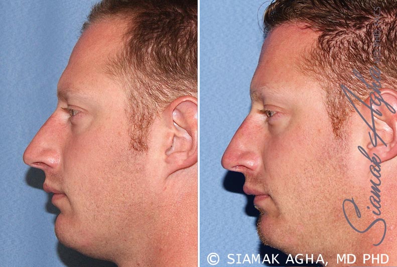 forehead reduction patient 2 left Newport Beach, CA