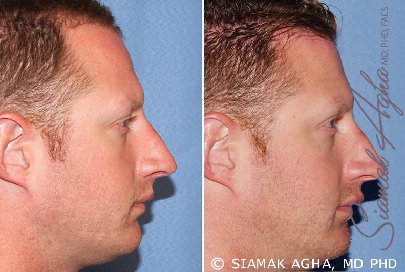 forehead reduction patient 2 right Newport Beach, CA
