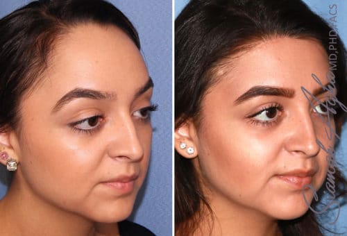 Forehead Reduction Patient 3