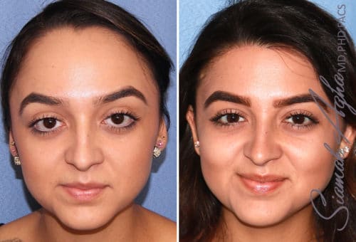 forehead reduction patient 3 front Newport Beach, CA
