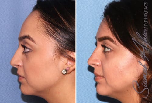 forehead reduction patient 3 left Newport Beach, CA