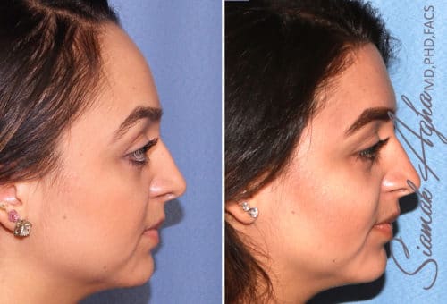 forehead reduction patient 3 right Newport Beach, CA