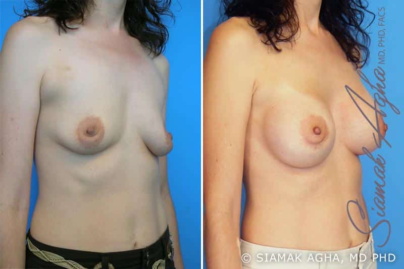 orange county breast augmentation patient 1 front right Newport Beach, CA