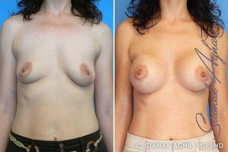 orange county breast augmentation patient 1 front Newport Beach, CA