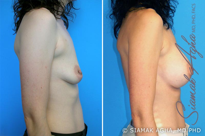 orange county breast augmentation patient 1 right Newport Beach, CA