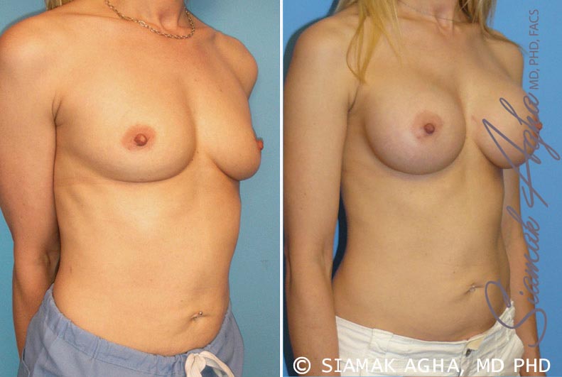 orange county breast augmentation patient 10 front right Newport Beach, CA