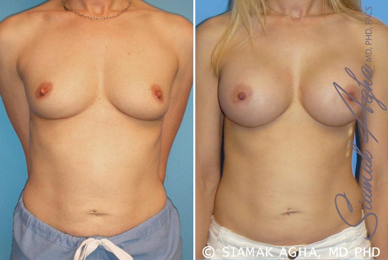 orange county breast augmentation patient 10 front Newport Beach, CA