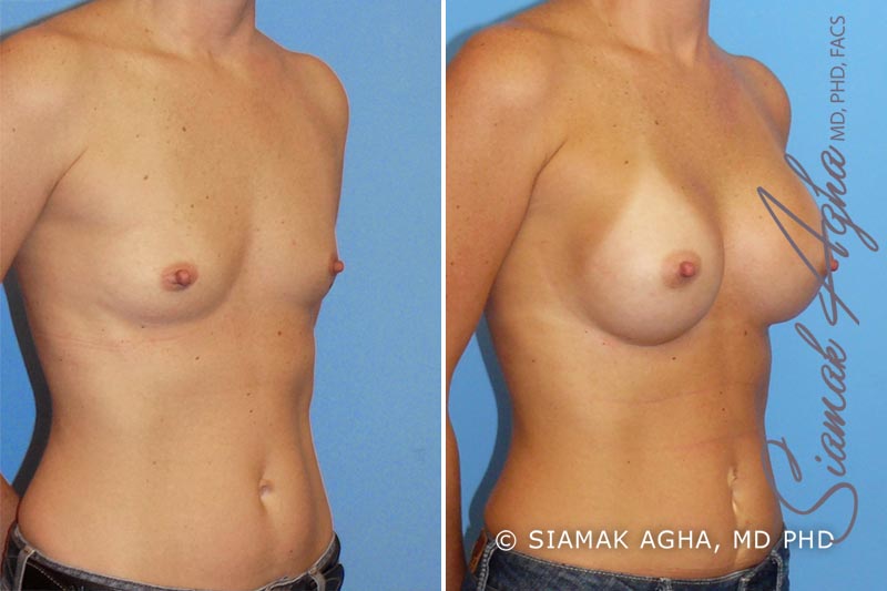 Breast Augmentation Patient 11