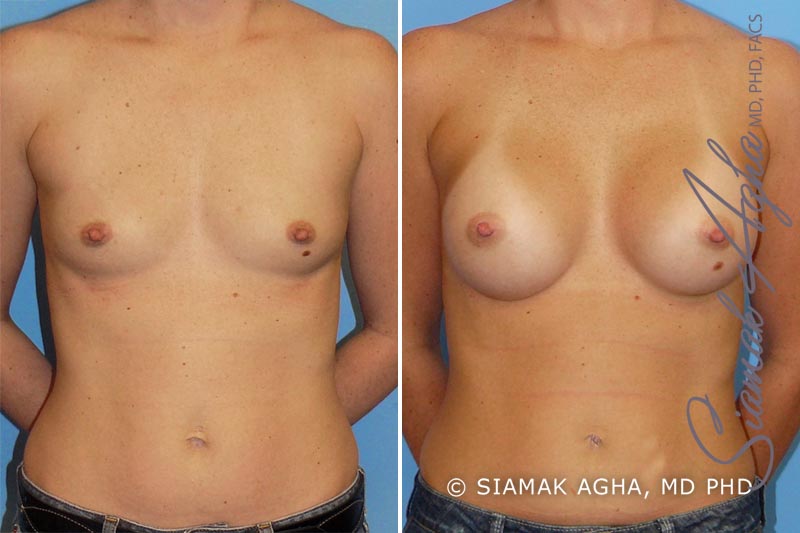 orange county breast augmentation patient 11 front Newport Beach, CA