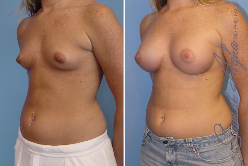 orange county breast augmentation patient 12 front left Newport Beach, CA