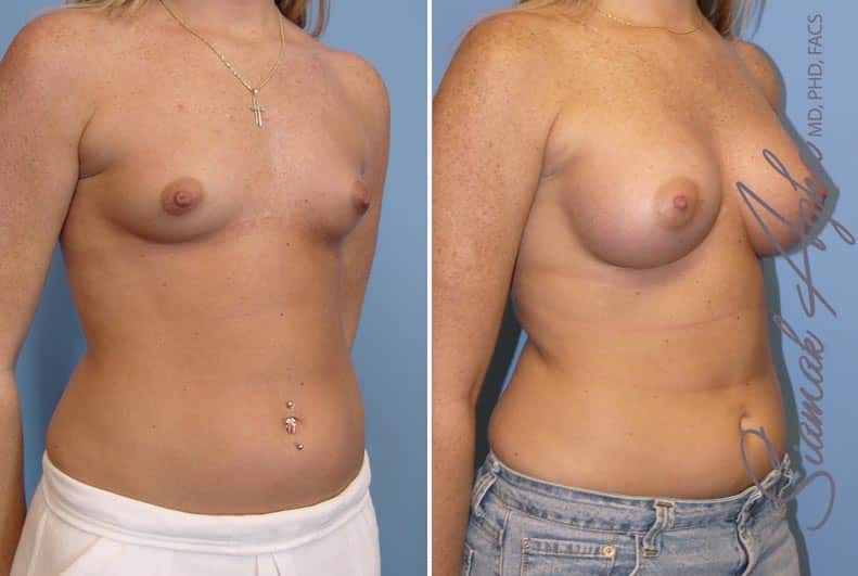 orange county breast augmentation patient 12 front right Newport Beach, CA