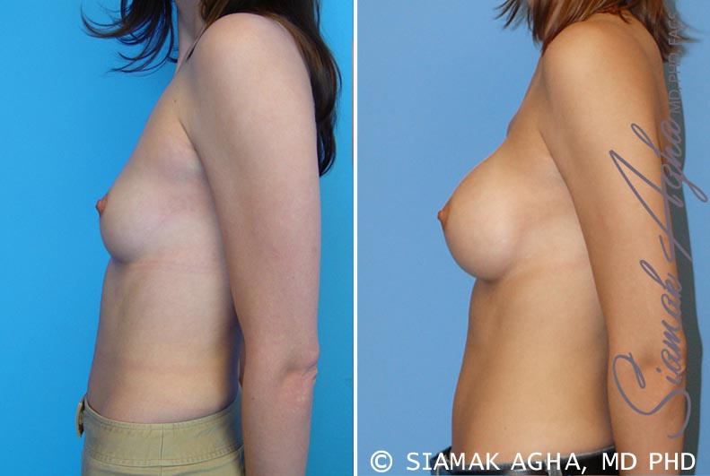 orange county breast augmentation patient 13 left Newport Beach, CA