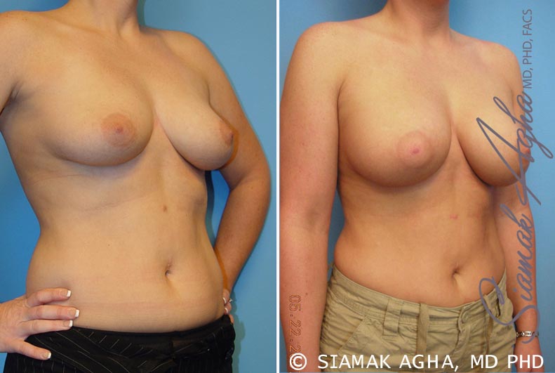 Breast Augmentation Patient 14