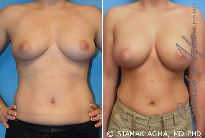 orange county breast augmentation patient 14 front Newport Beach, CA
