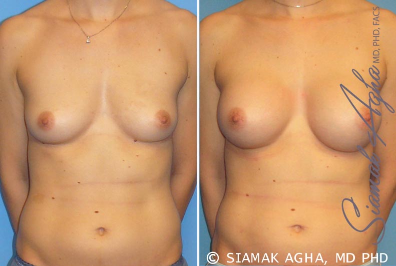 orange county breast augmentation patient 15 front Newport Beach, CA