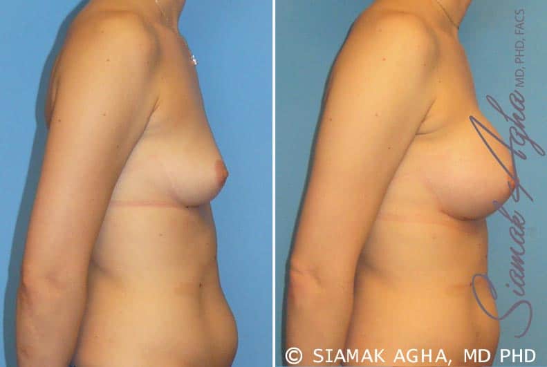 Breast Augmentation Patient 15