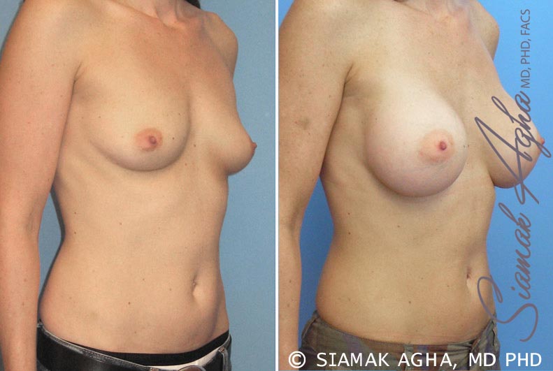 orange county breast augmentation patient 16 front right Newport Beach, CA
