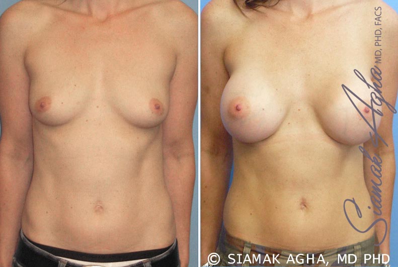 orange county breast augmentation patient 16 front Newport Beach, CA