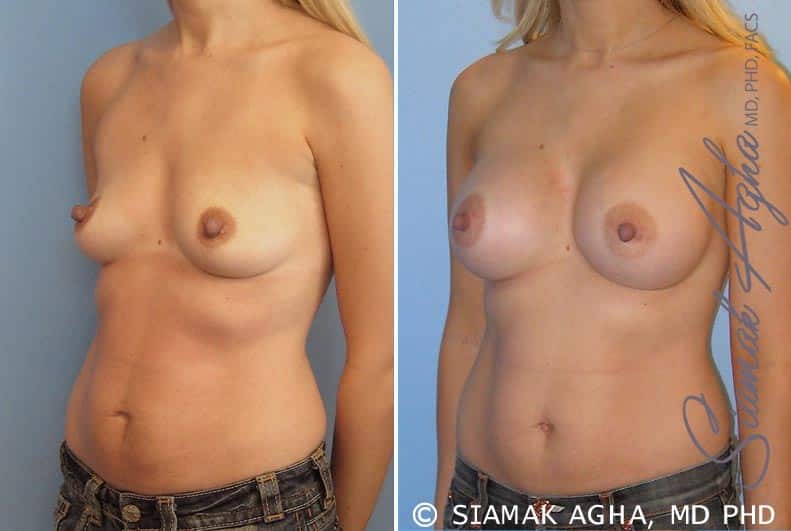 orange county breast augmentation patient 17 front left Newport Beach, CA