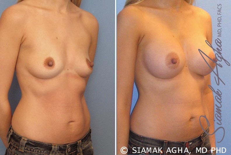 orange county breast augmentation patient 17 front right Newport Beach, CA