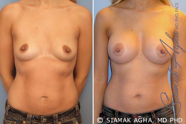 orange county breast augmentation patient 17 front Newport Beach, CA
