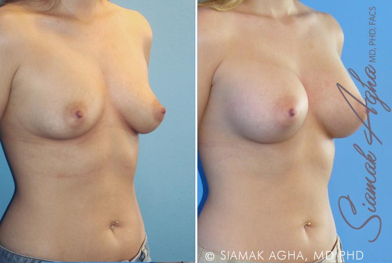 orange county breast augmentation patient 18 front right Newport Beach, CA