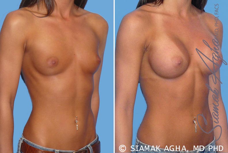 orange county breast augmentation patient 19 front right Newport Beach, CA