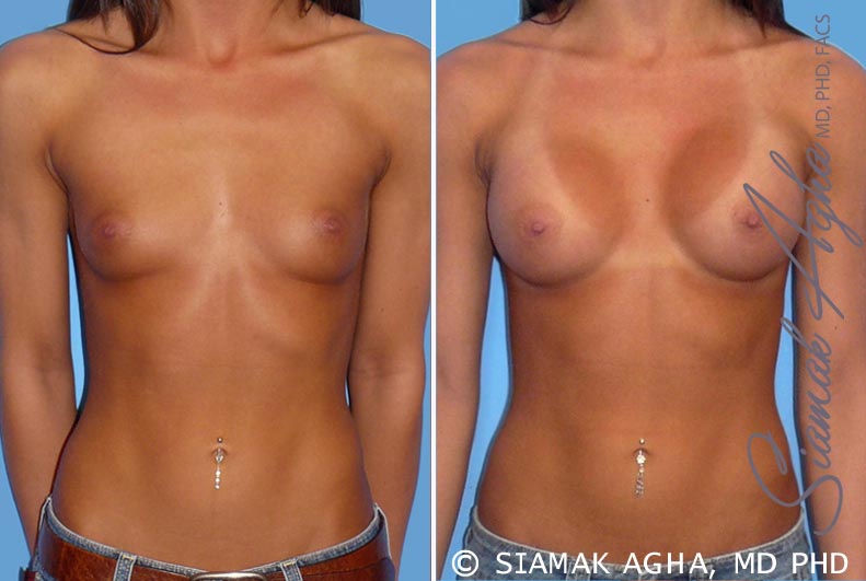 orange county breast augmentation patient 19 front Newport Beach, CA