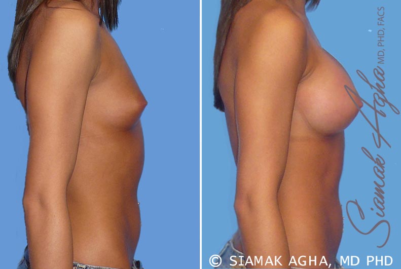 Breast Augmentation Patient 19
