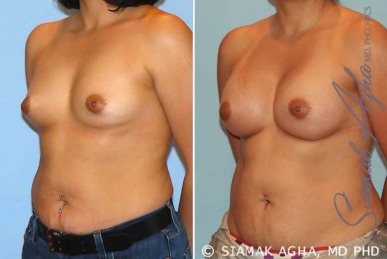 Breast Augmentation Patient 20