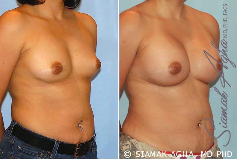 orange county breast augmentation patient 20 front right Newport Beach, CA