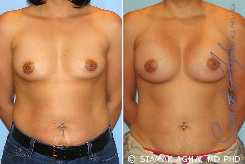 orange county breast augmentation patient 20 front Newport Beach, CA
