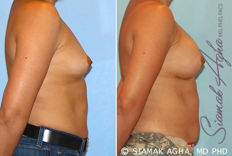 orange county breast augmentation patient 20 right Newport Beach, CA