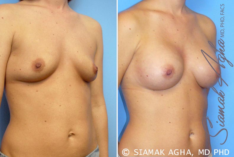 orange county breast augmentation patient 21 front right Newport Beach, CA