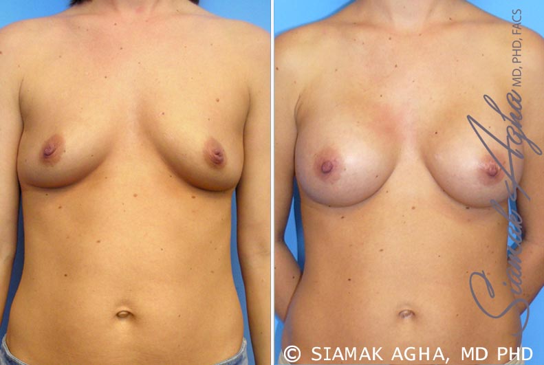 orange county breast augmentation patient 21 front Newport Beach, CA