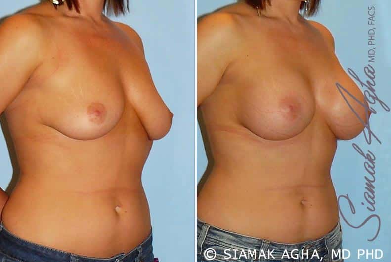 orange county breast augmentation patient 22 front right Newport Beach, CA