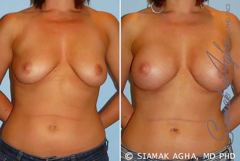 orange county breast augmentation patient 22 front Newport Beach, CA
