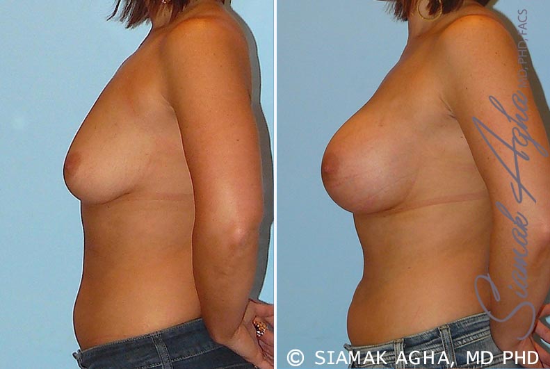 orange county breast augmentation patient 22 left Newport Beach, CA