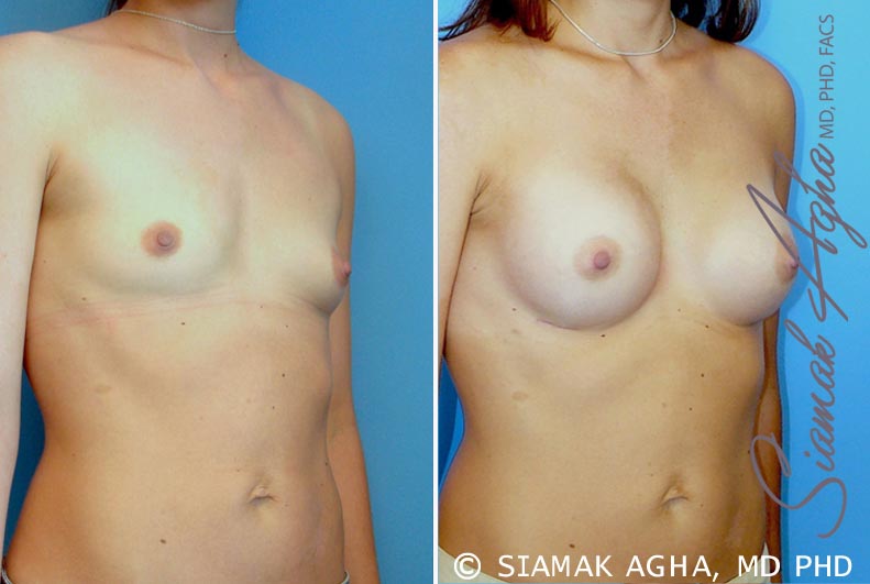 orange county breast augmentation patient 23 front right Newport Beach, CA