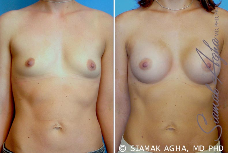 orange county breast augmentation patient 23 front Newport Beach, CA