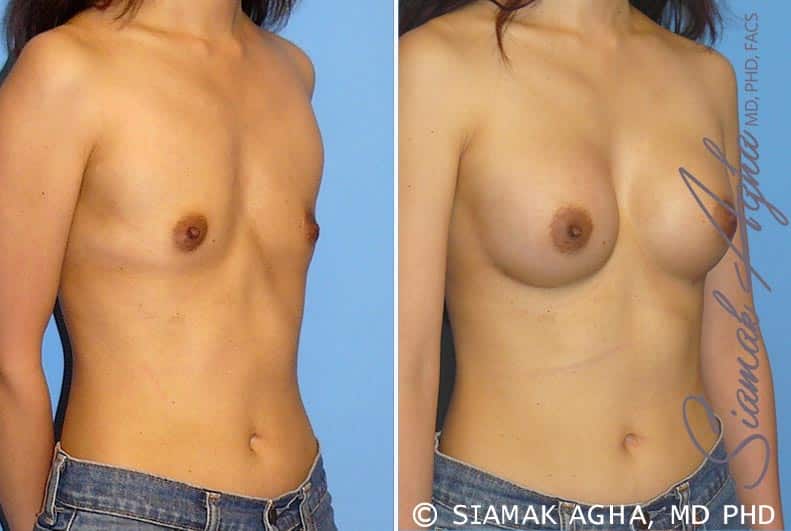 Breast Augmentation Patient 24