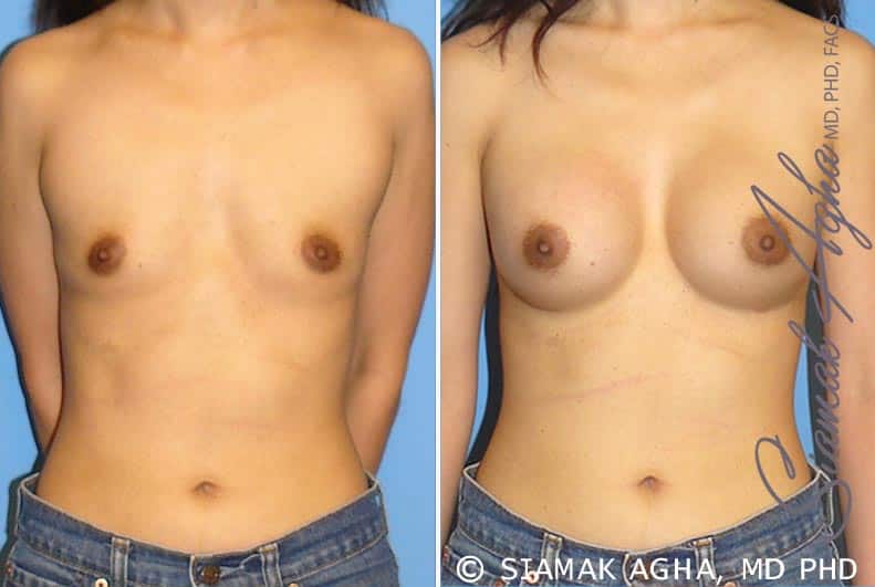orange county breast augmentation patient 24 front Newport Beach, CA