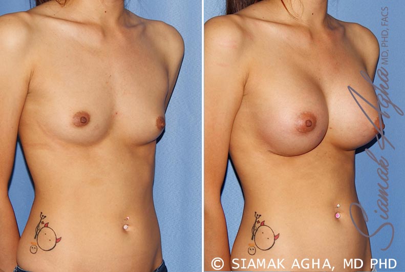 Breast Augmentation Patient 25