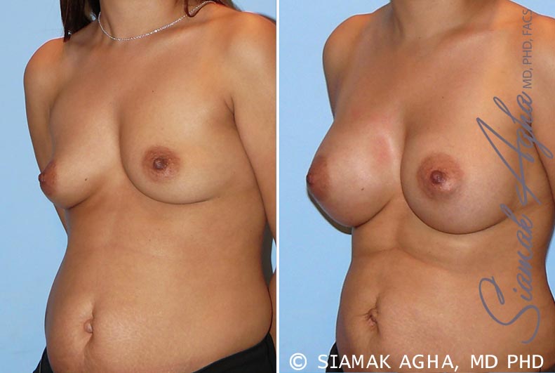 orange county breast augmentation patient 26 front left Newport Beach, CA