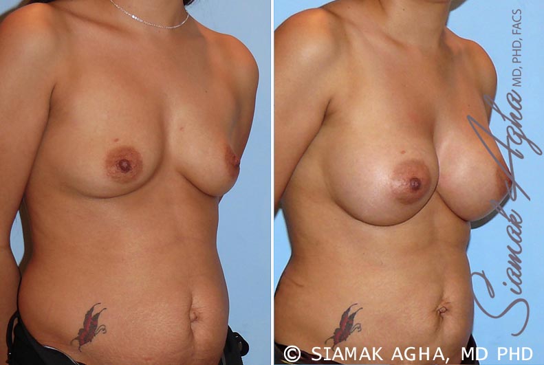 orange county breast augmentation patient 26 front right Newport Beach, CA